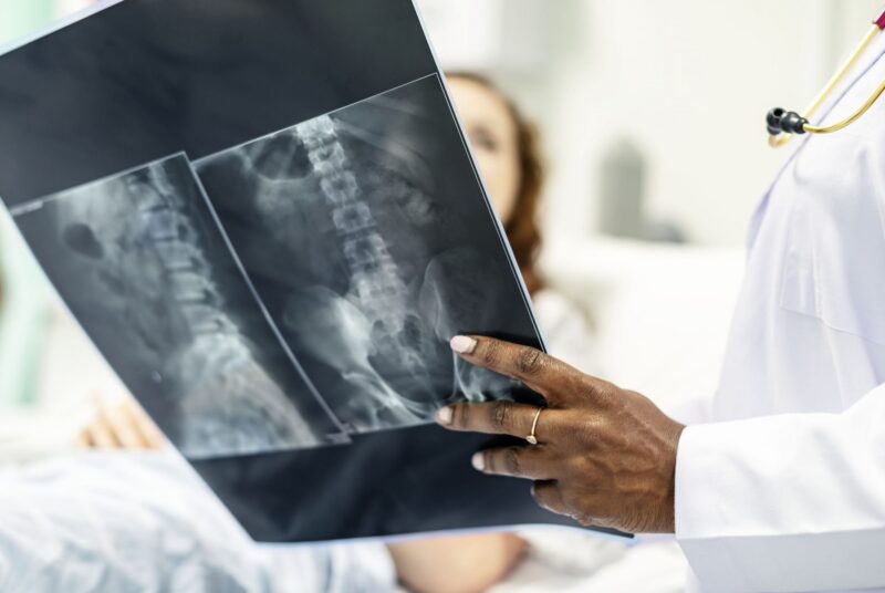 Recoverable Damages After a Spinal Cord Injury