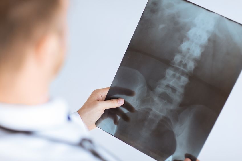 If you’re living with a spinal cord injury, you may be entitled to compensation.